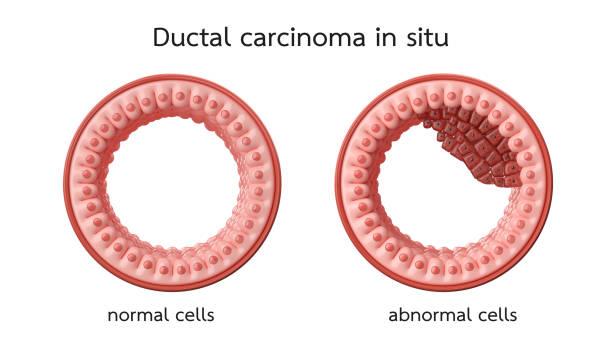 breast cancer - gland lobule imagens e fotografias de stock