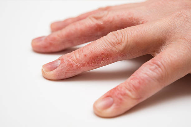 сухой потрескавшейся коже состояние, экзема - dermatitis dry human hand human skin стоковые фото и изображения