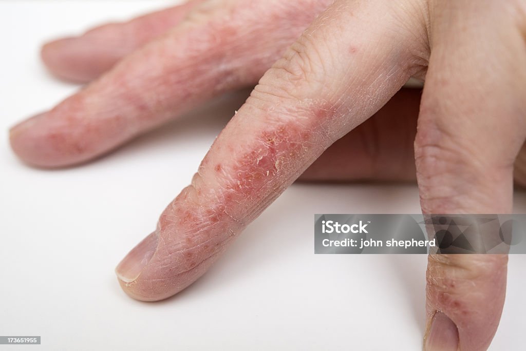 Dry Cracked Skin Condition, Eczema Medical Image. Cracked Stock Photo