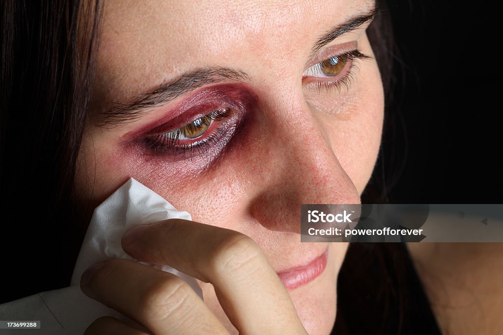 Woman With Black Eye *THIS IS NO REAL - SPECIAL EFFECTS MAKE UP* Woman with black eye holding tissue One Woman Only Stock Photo