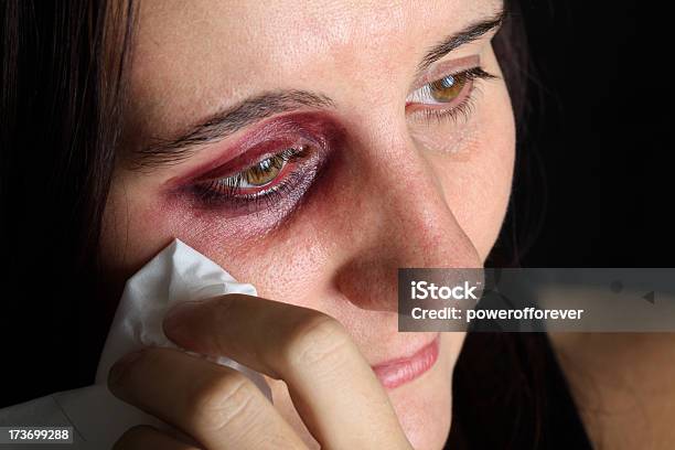 Woman With Black Eye Stock Photo - Download Image Now - One Woman Only, Women, Bruise