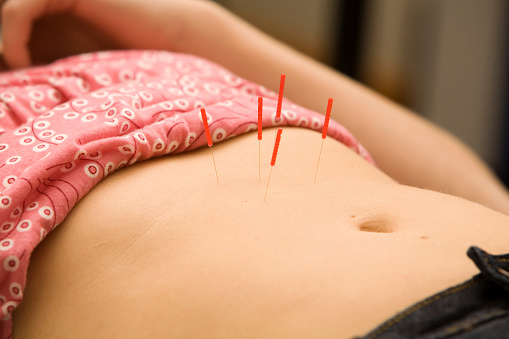 Acupuncture being performed on a woman's stomach. Shallow DOF.  Please view all images from this series along with all