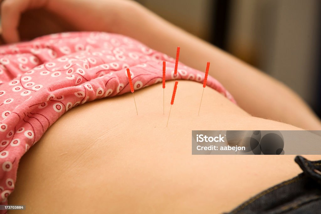Akupunktura - Zbiór zdjęć royalty-free (Akupunktura)