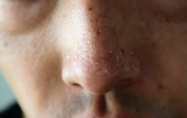 istock Close up of sunburned nose 1737077461