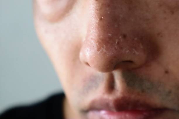 istock Close up of sunburned nose 1737078005