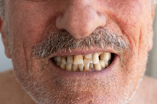 Smile With Missing Tooth.Broken Tooth Absence