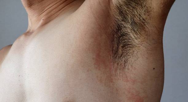 istock Japanese man's armpit with rough skin 1737097106