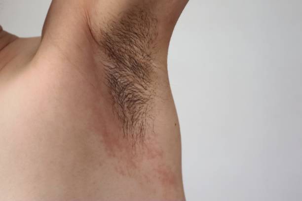 istock Japanese man's armpit with rough skin 1737098731