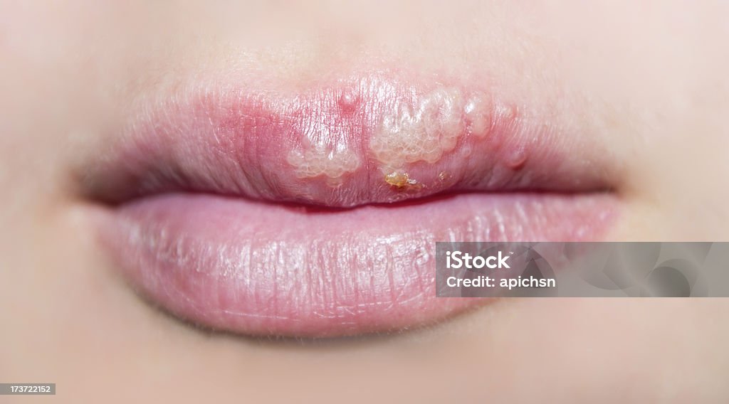 A close-up of lips that have herpes on the upper lip The photo shows manifestations of herpes on the lips of a girl Cold Sore Stock Photo