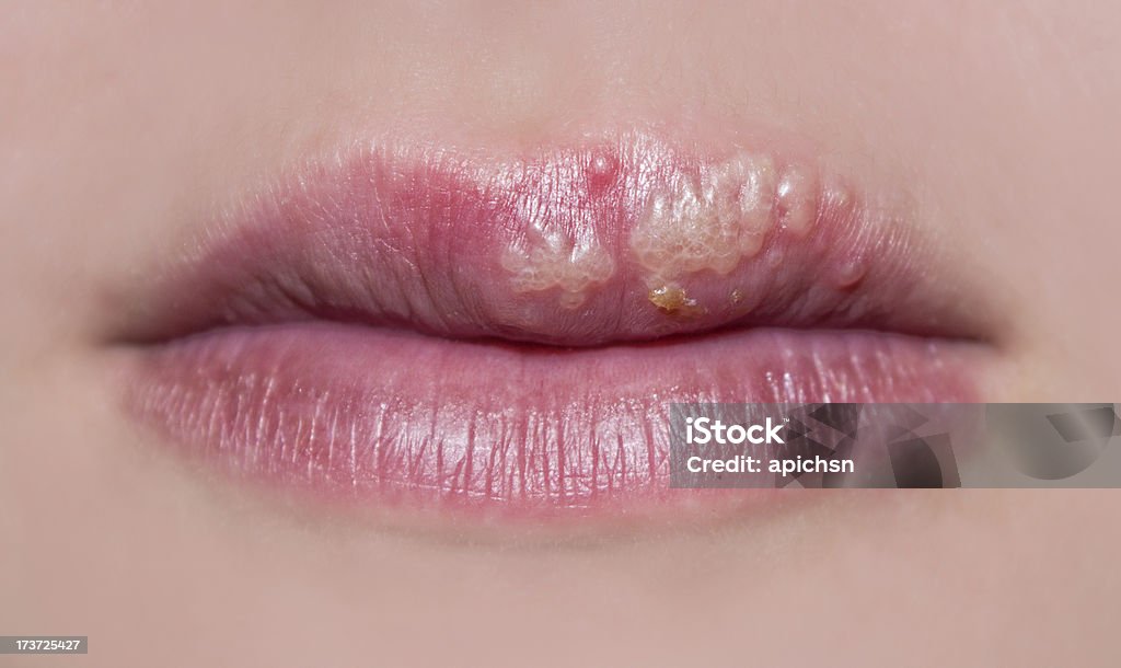 manifestation of herpes The photo shows manifestations of herpes on the lips of a girl Cold Sore Stock Photo