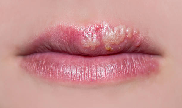 manifestation of herpes The photo shows manifestations of herpes on the lips of a girl Cold Sore stock pictures, royalty-free photos & images