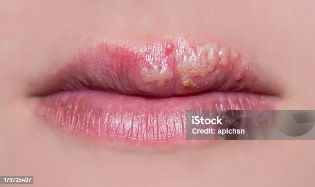 Manifestation Of Herpes Stock Photo - Download Image Now - Cold Sore, Herpes, Human Lips