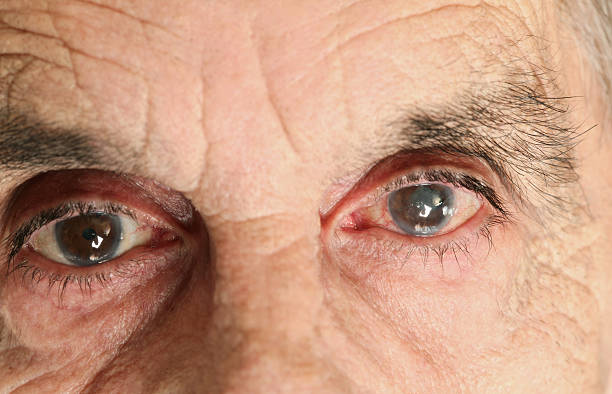 istock Close-up look of an old man with eye problems 173819292