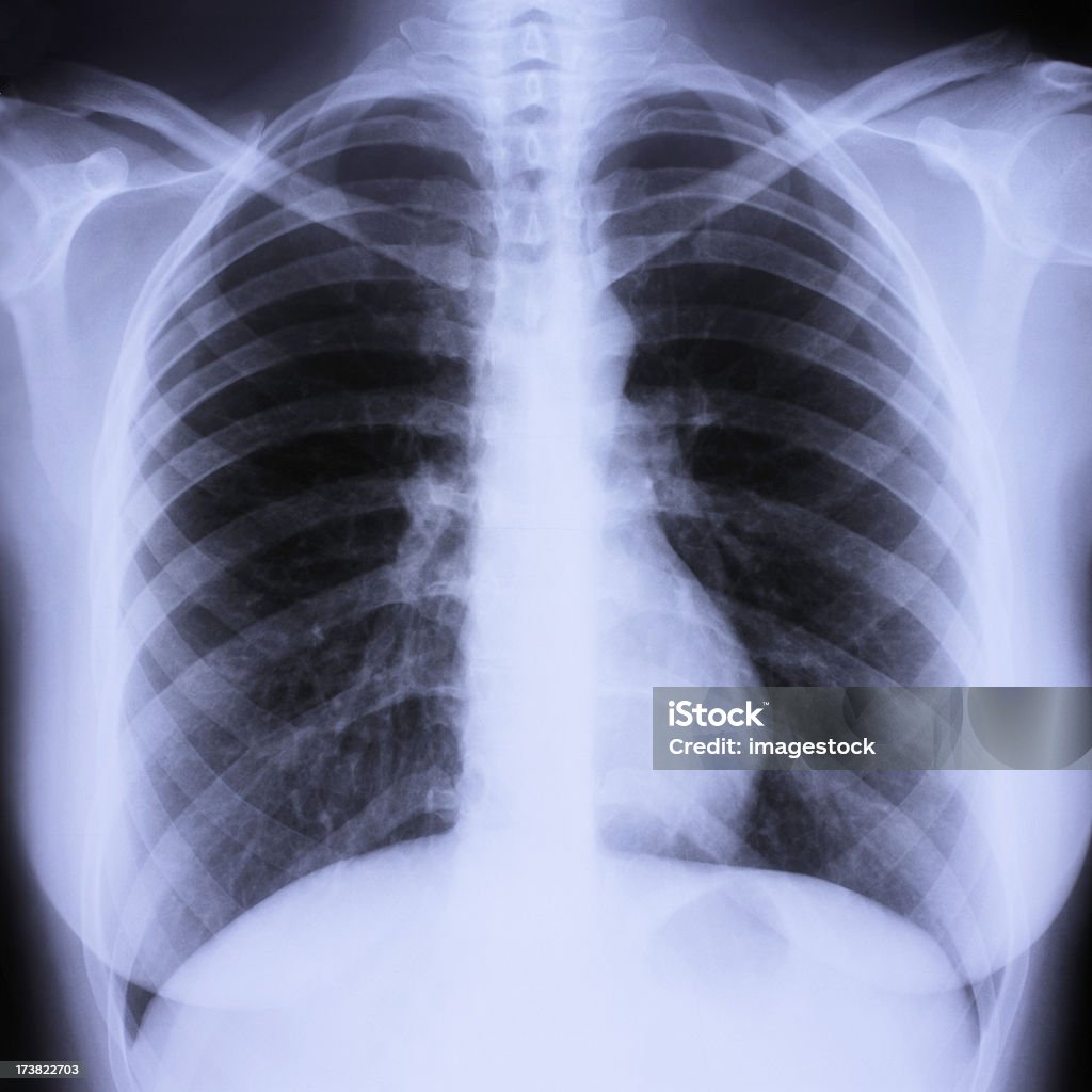 Radiografía de tórax - Foto de stock de Anatomía libre de derechos