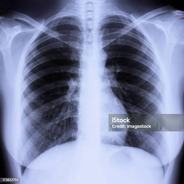 Radiografía De Tórax Foto de stock y más banco de imágenes de Anatomía - Anatomía, Asistencia sanitaria y medicina, Azul