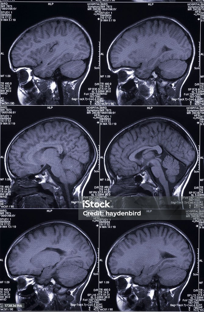 MRI는 뇌 스캔 표시중 여러 영상을 헤드 및 스컬 - 로열티 프리 측두엽 스톡 사진
