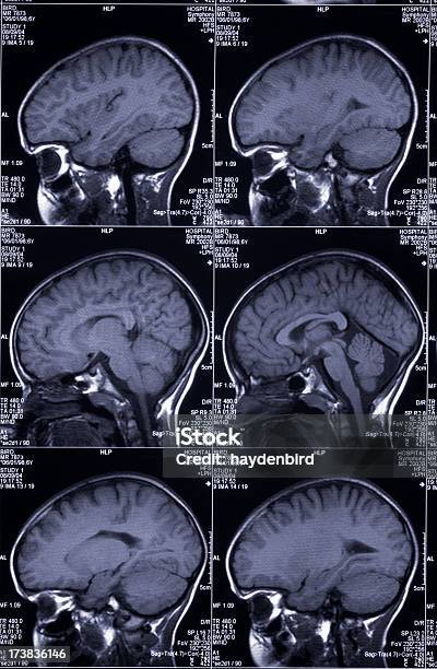 Mri는 뇌 스캔 표시중 여러 영상을 헤드 및 스컬 측두엽에 대한 스톡 사진 및 기타 이미지 - 측두엽, MRI 스캔, X-레이
