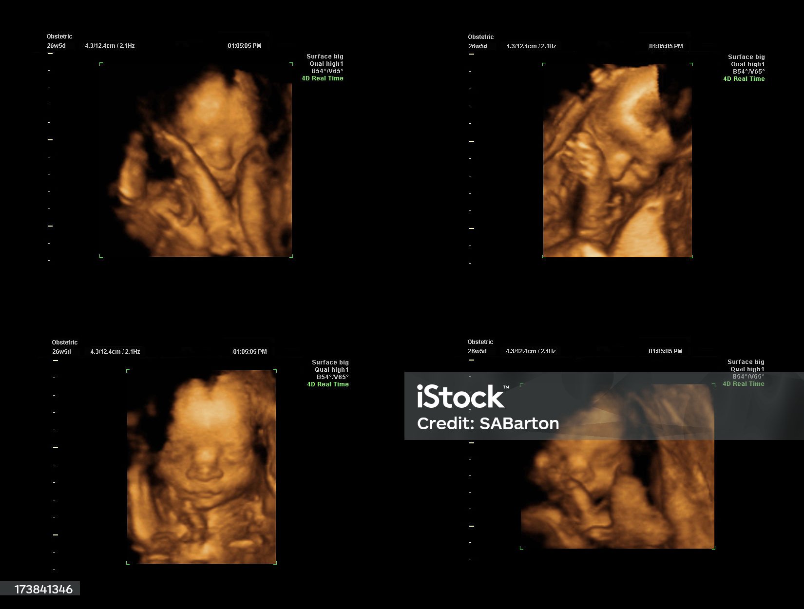 3D ultrasound of fœtus