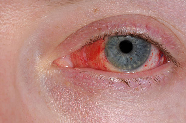 istock A close-up of a human eye with red spots 173845473