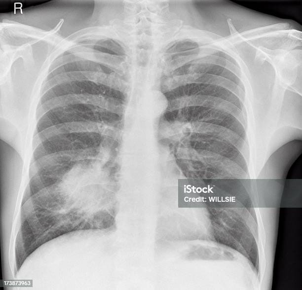 Photo libre de droit de Poitrine Xray Du Cancer Du Poumon À Un Homme banque d'images et plus d'images libres de droit de Adulte - Adulte, Cage thoracique, Cancer