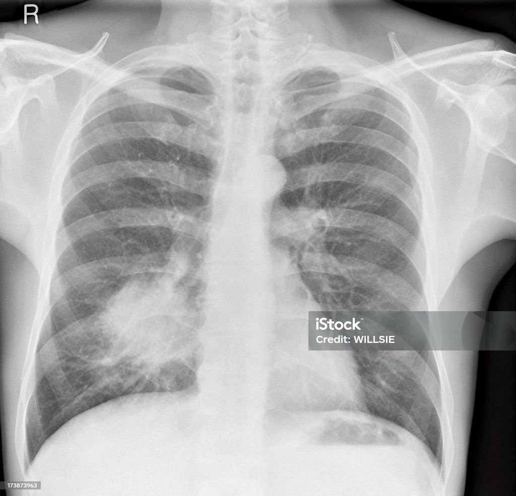 chest x-ray of lung cancer in a man A digital chest x-ray of a male smoker with a large tumour in the right lung. The white opacity representing the tumour in the right lower lobe is spiculated. Typical appearances of lung cancer. Adult Stock Photo