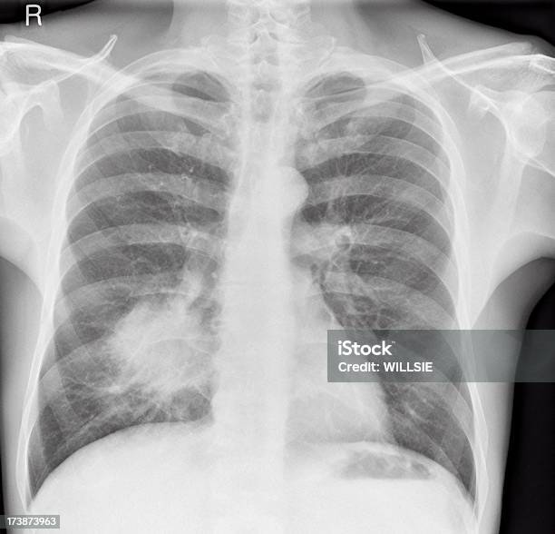 Chest Xray Of Lung Cancer In A Man Stock Photo - Download Image Now - Adult, Black And White, Cancer - Illness