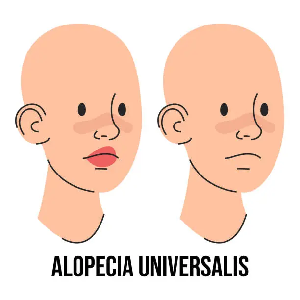 Vector illustration of Alopecia universalis vector isolated. Two characters