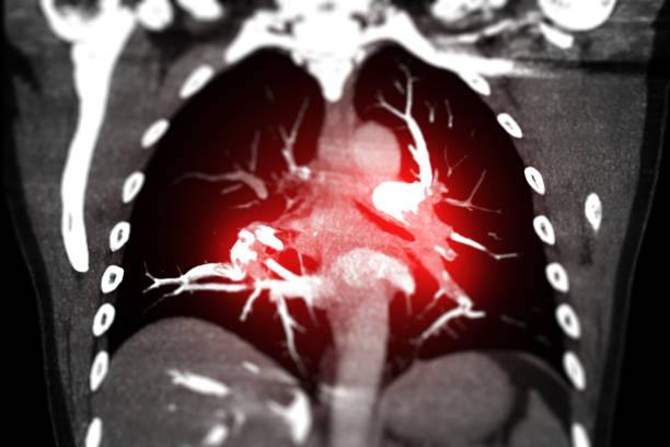 CTA Chest  or CTPA with contrast media coronal view showing Pulmonary embolism (PE) . stock photo