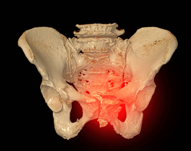 istock CT Scan of pelvic bone  3D rendering image showing superior pubic ramus fracture. 1739105683