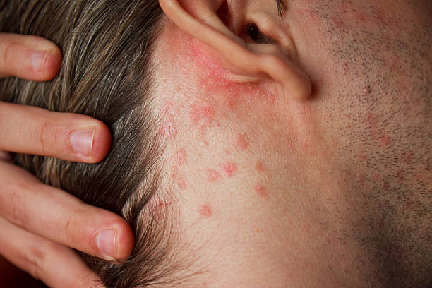 Rash Psoriasis skin disorder on neck photo psoriasis stock pictures, royalty-free photos & images