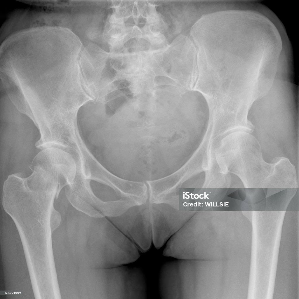 Radiografia pelvico di osteoporosi con fracture destra del collo del femore - Foto stock royalty-free di Femore