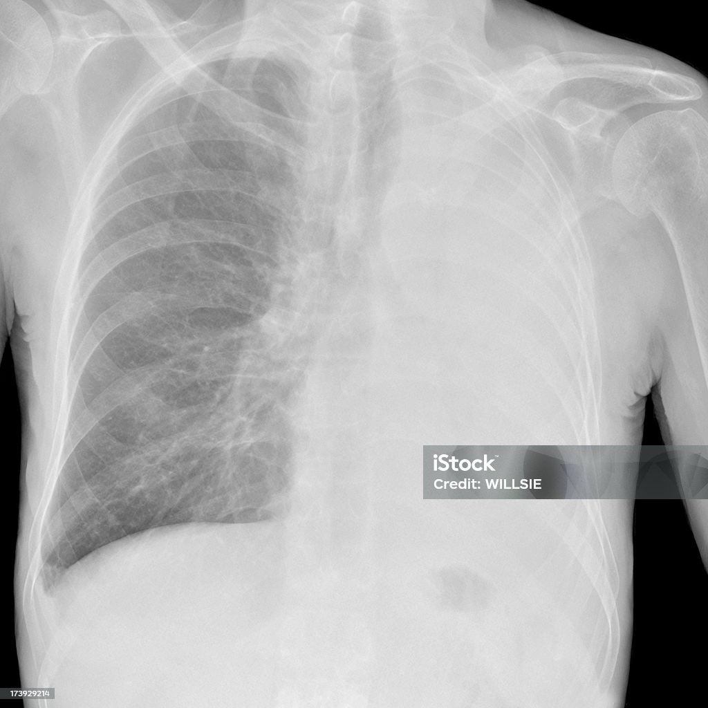 Endormis lung digital poitrine x-ray eg de l'asthme et contre le cancer - Photo de Pneumothorax libre de droits