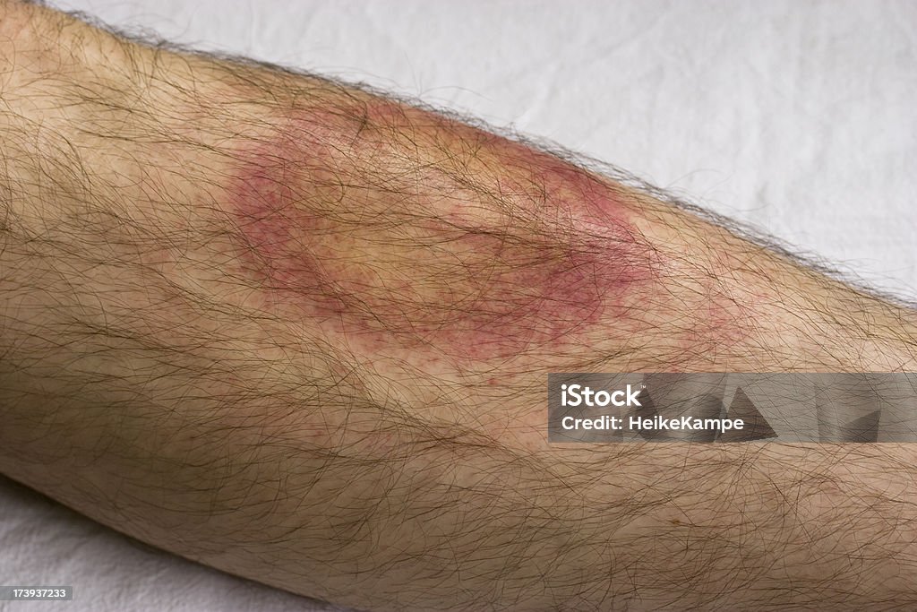 Lyme disease Borreliosis after a tick bite. Lyme Disease Stock Photo