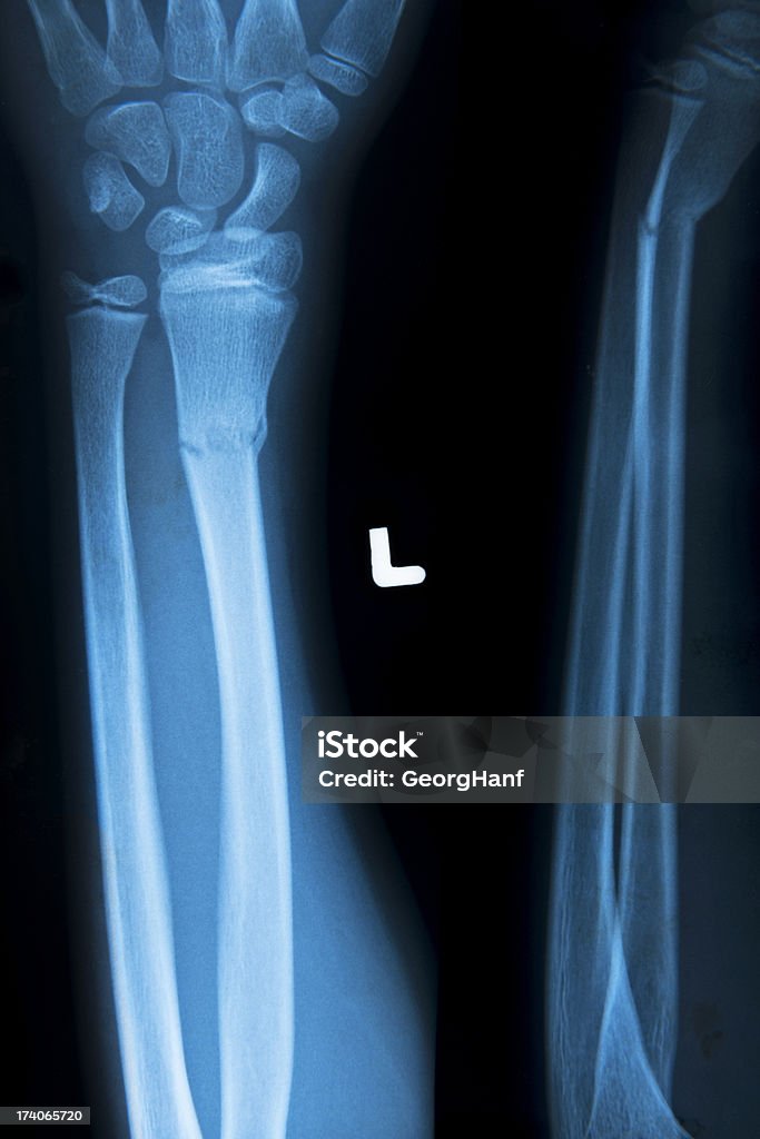 Human hand bone X-Ray image of the human hand bone. Side and front view.The letter L is the left side. Anatomy Stock Photo