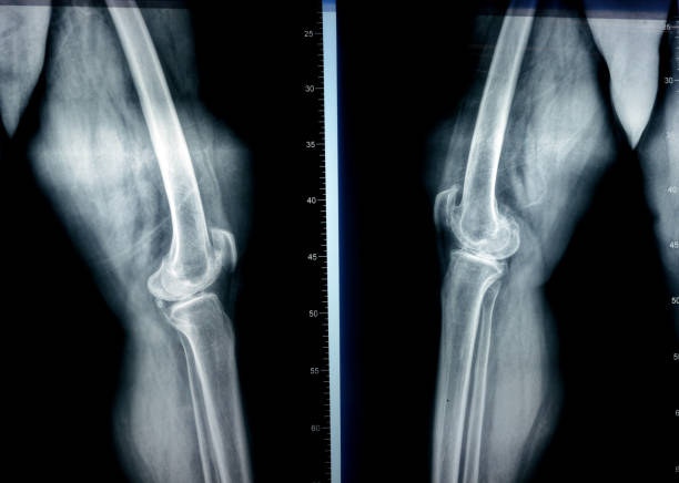 istock Plain X ray of both knee joints shows apparent joint osteoarthritis according to Kellgren and Lawrence system for classification of osteoarthritis with definite osteophytes and joint space narrowing 1741386510