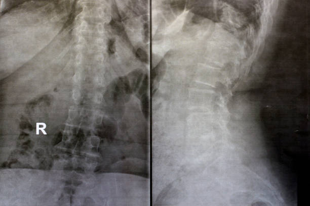 a radiografia simples da coluna dorsal e lombar revela alterações espondilóticas, endireitamento das espinhas dorsal e lombar, os espaços do disco intervertebral estão intactos, espondilose das espinhas dorsal e lombar - x ray image x ray back low - fotografias e filmes do acervo