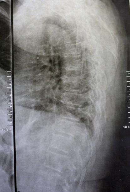 a radiografia simples da coluna dorsal e lombar revela alterações espondilóticas, endireitamento das espinhas dorsal e lombar, os espaços do disco intervertebral estão intactos, espondilose das espinhas dorsal e lombar - x ray image x ray back low - fotografias e filmes do acervo