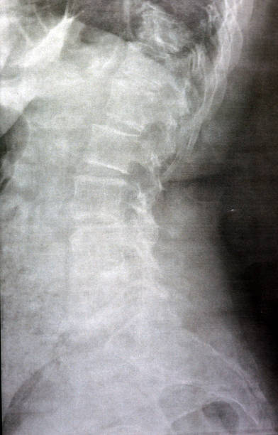 등뼈 및 요추의 일반 x선은 척추 변화, 등뼈 및 요추의 곧게 펴짐, 추간판 공간이 손상되지 않음, 등뼈 및 요추 척추의 척추증을 나타냅니다 - x ray image x ray back low 뉴스 사진 이미지