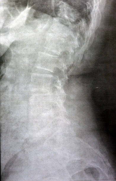 a radiografia simples da coluna dorsal e lombar revela alterações espondilóticas, endireitamento das espinhas dorsal e lombar, os espaços do disco intervertebral estão intactos, espondilose das espinhas dorsal e lombar - x ray image x ray back low - fotografias e filmes do acervo