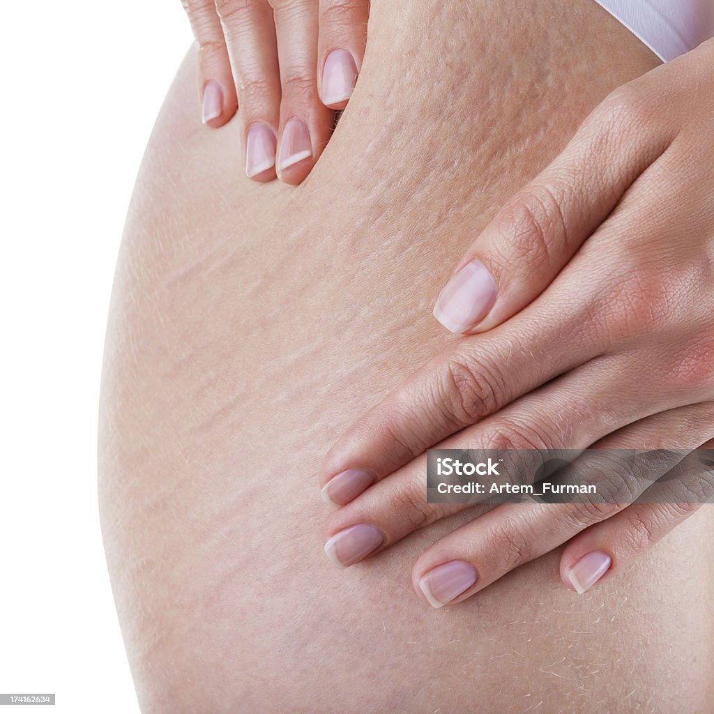 Stretch marks and cellulite A woman is testing the skin on the thigh for the presence of stretch marks and cellulite Stretch Mark Stock Photo