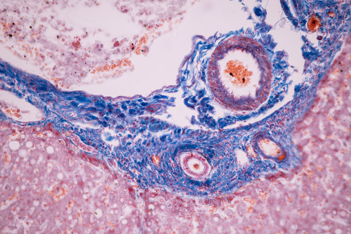Paraganglioma is a type of neuroendocrine tumor that forms near certain blood vessels and nerves outside of the adrenal glands. The adrenal glands are important for making hormones that control many functions in the body and are located on top of the kidneys.