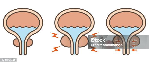Vector Illustration Of Normal Prostate And Prostatic Hypertrophy向量圖形及更多 ...