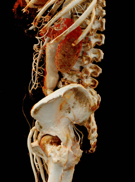 istock CTA abdominal aorta showing abdomenal aortic dissection 3D rendering. 1741980034