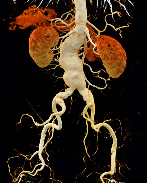 istock CTA abdominal aorta showing abdomenal aortic dissection 3D rendering. 1741981129