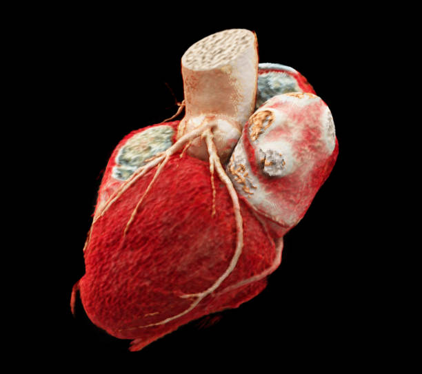 istock CTA Coronary artery  3D rendering image showing coronary tree and heart 3D. 1741984456