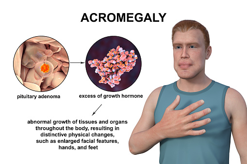 Acromegaly, 3D illustration showing an increase in the size of the hands and face due to overproduction of somatotrophin caused by a tumor of the pituitary gland.