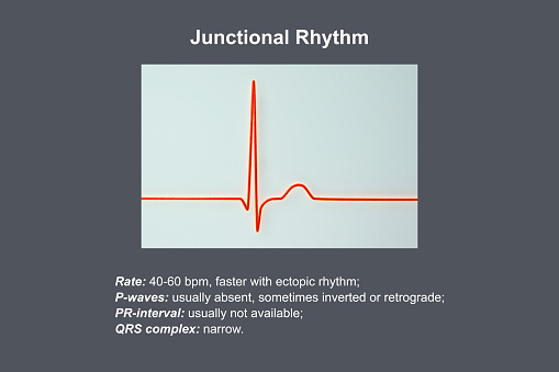 Electrocardiogram displaying a junctional rhythm, which occurs when the electrical signals in the heart originate from the atrioventricular junction instead of the sinoatrial node, 3D illustration.