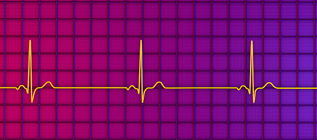 A detailed 3D illustration of an electrocardiogram displaying sinus bradycardia, a condition characterized by a slow heart rate originating from the sinus node, typically below 60 beats per minute.