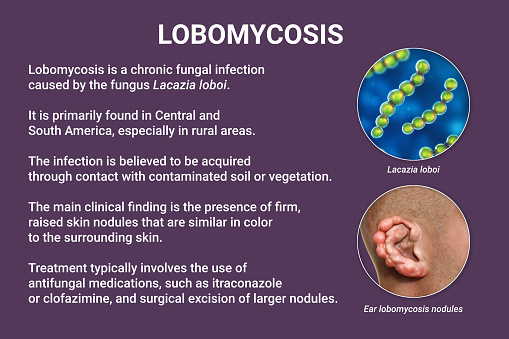 Lobomycosis, a chronic skin disease caused by microscopic fungi Lacazia loboi and characterized by nodular and keloidal lesions primarily affecting the limbs and ears, 3D illustration