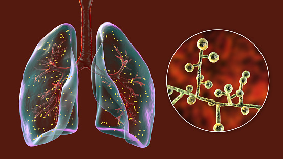 Lung adiaspiromycosis, a rare respiratory infection caused by the fungus Emmonsia spp., characterized by the presence of enlarged encapsulated fungal spores within lung tissues, 3D illustration.